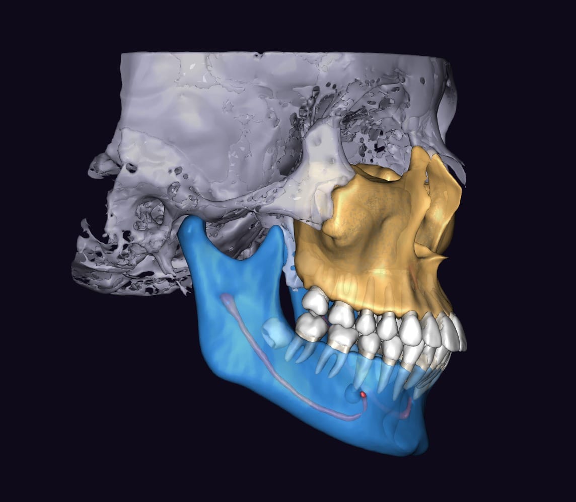 Tomographie 3D des deux mâchoires avec ATM – 3D Dental, X-ray