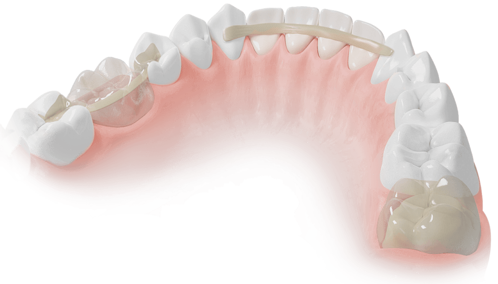 ADM Dentapreg & Fibrafill – Dentapreg - ADM, a.s, Composites