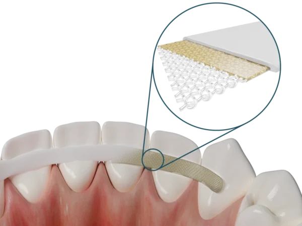 Dentapreg® SFM – Dentapreg - ADM, a.s, Stumpfaufbauten