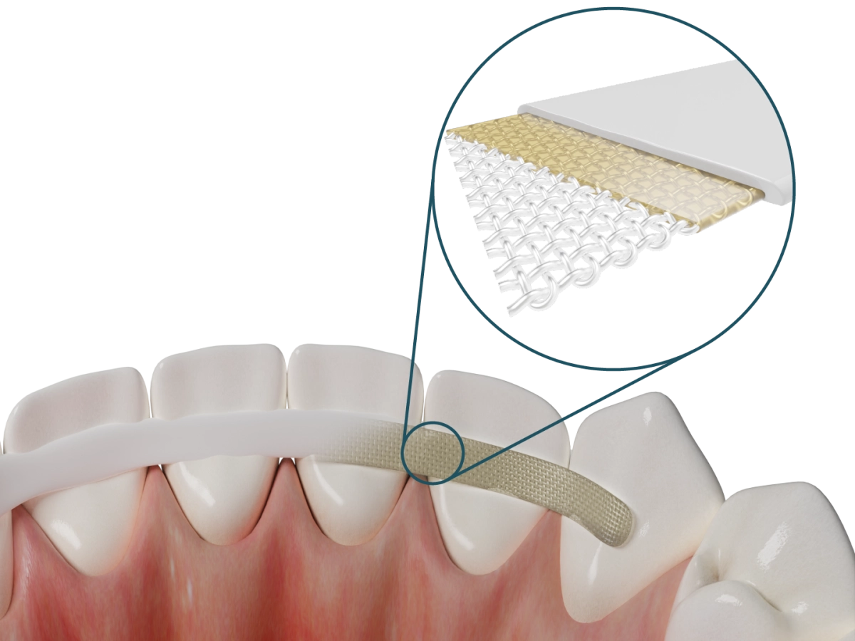 Dentapreg® SFM – Dentapreg - ADM, a.s, Other Splints