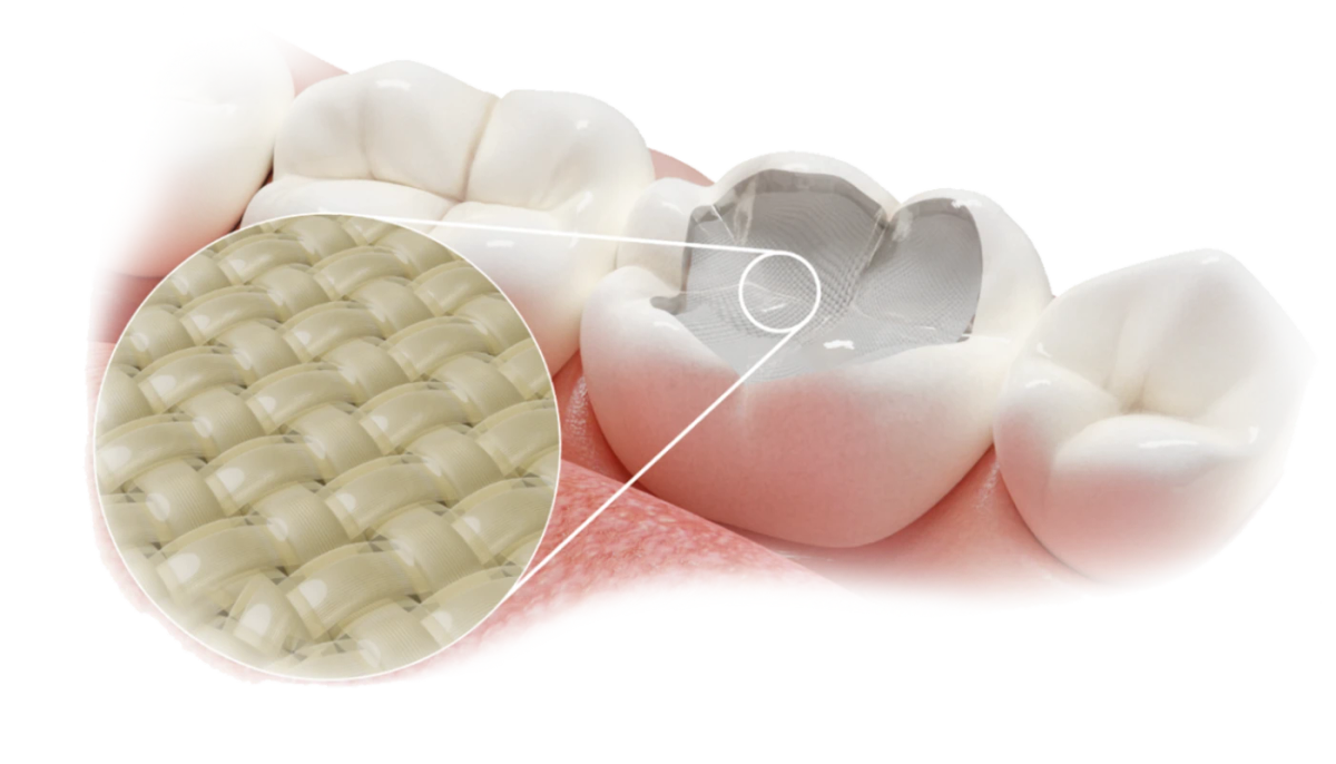 Fibrafill – Dentapreg - ADM, a.s, Composites