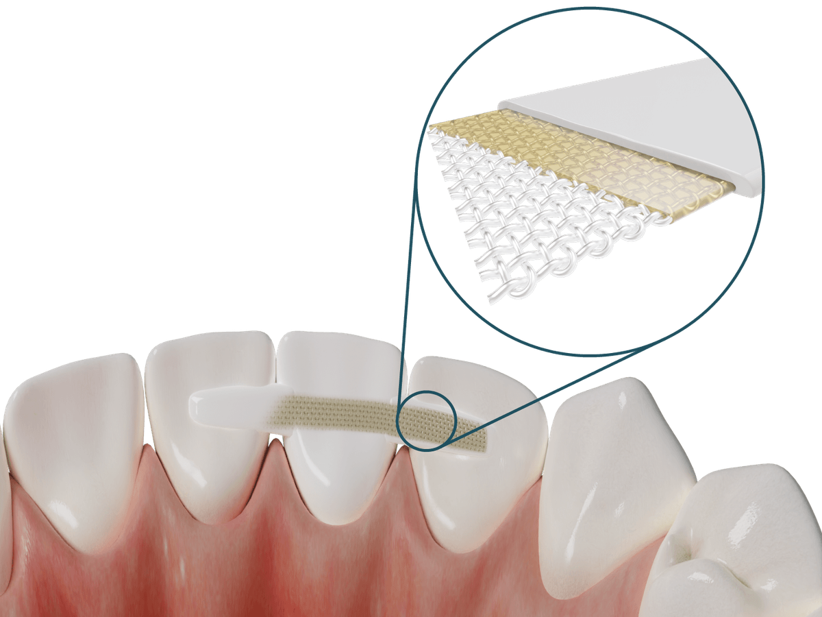 Dentapreg® PFM – Dentapreg - ADM, a.s, Temporary Crowns