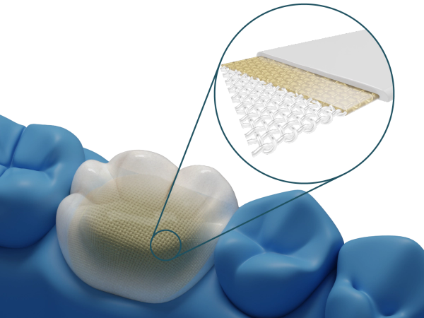 Dentapreg® VEIL