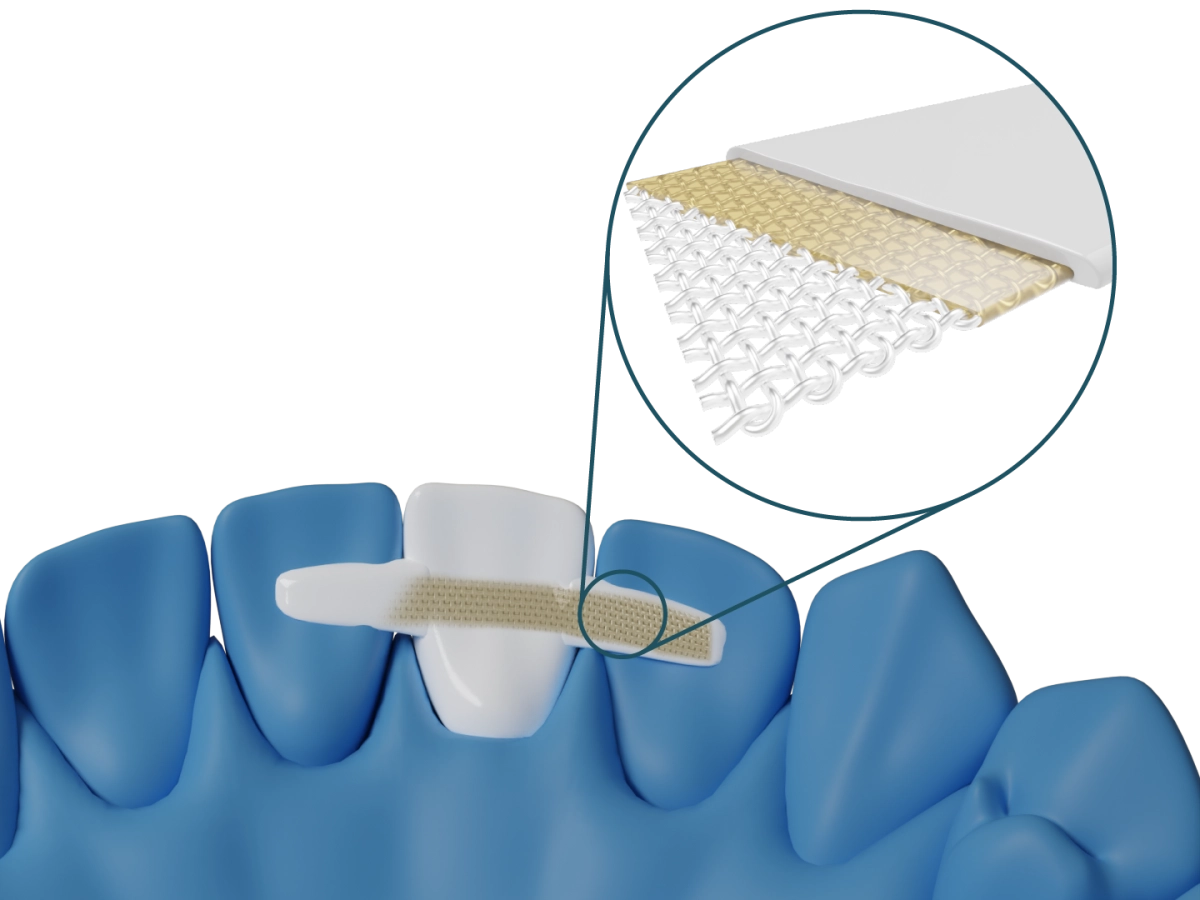 Dentapreg® BRAID – Dentapreg - ADM, a.s, Temporary Crowns