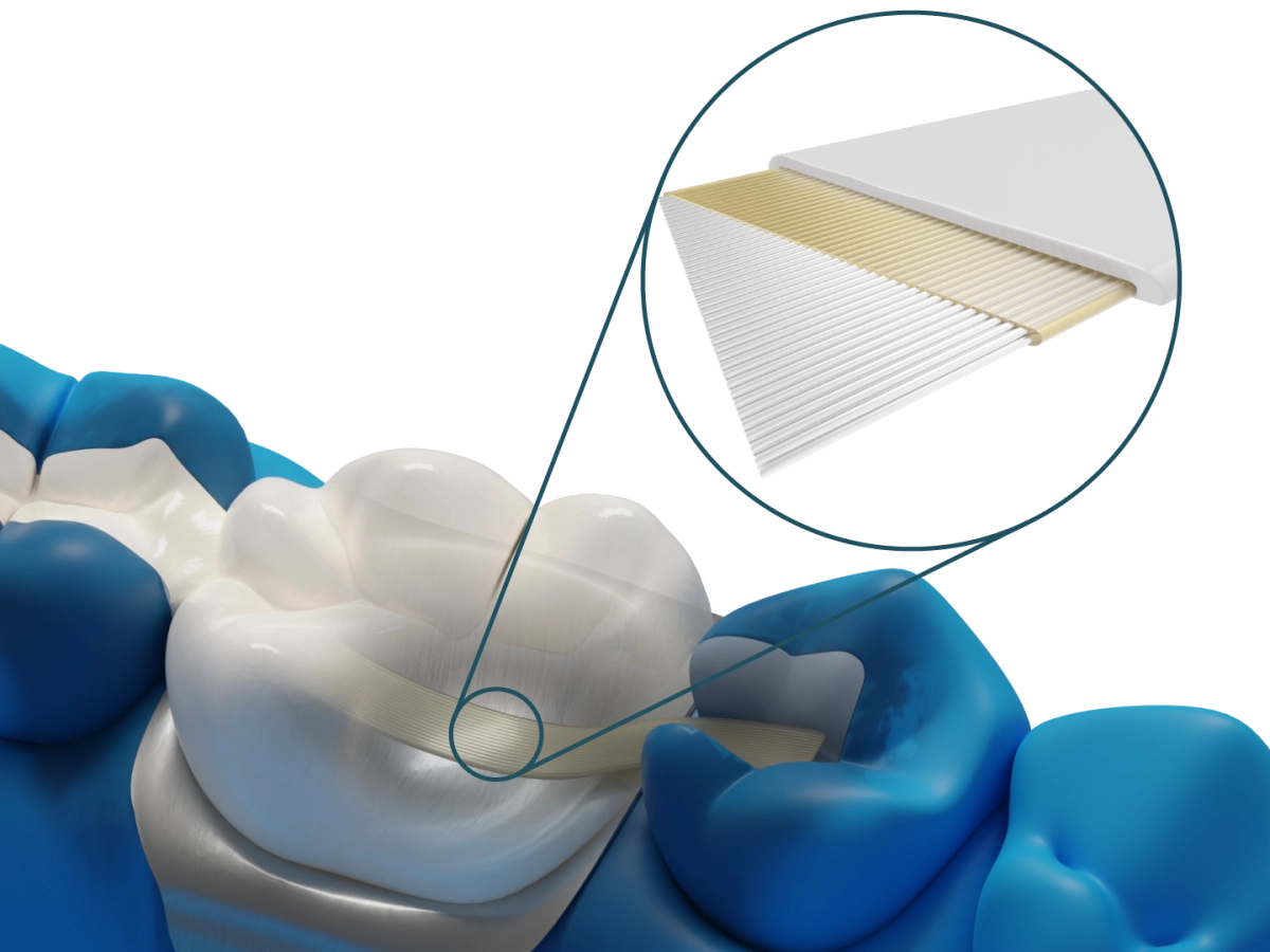 Dentapreg® BUNDLE – Dentapreg - ADM, a.s, Temporary Crowns