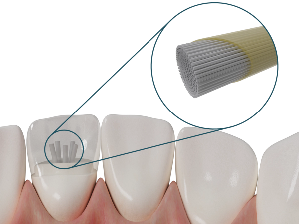 Dentapreg® PINPOST