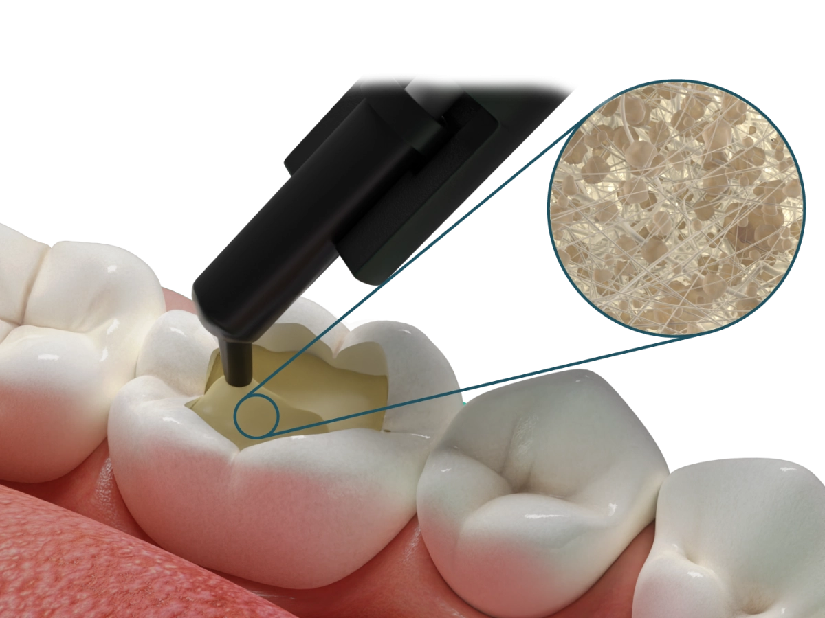 Fibrafill® DENTIN – Dentapreg - ADM, a.s, Composites