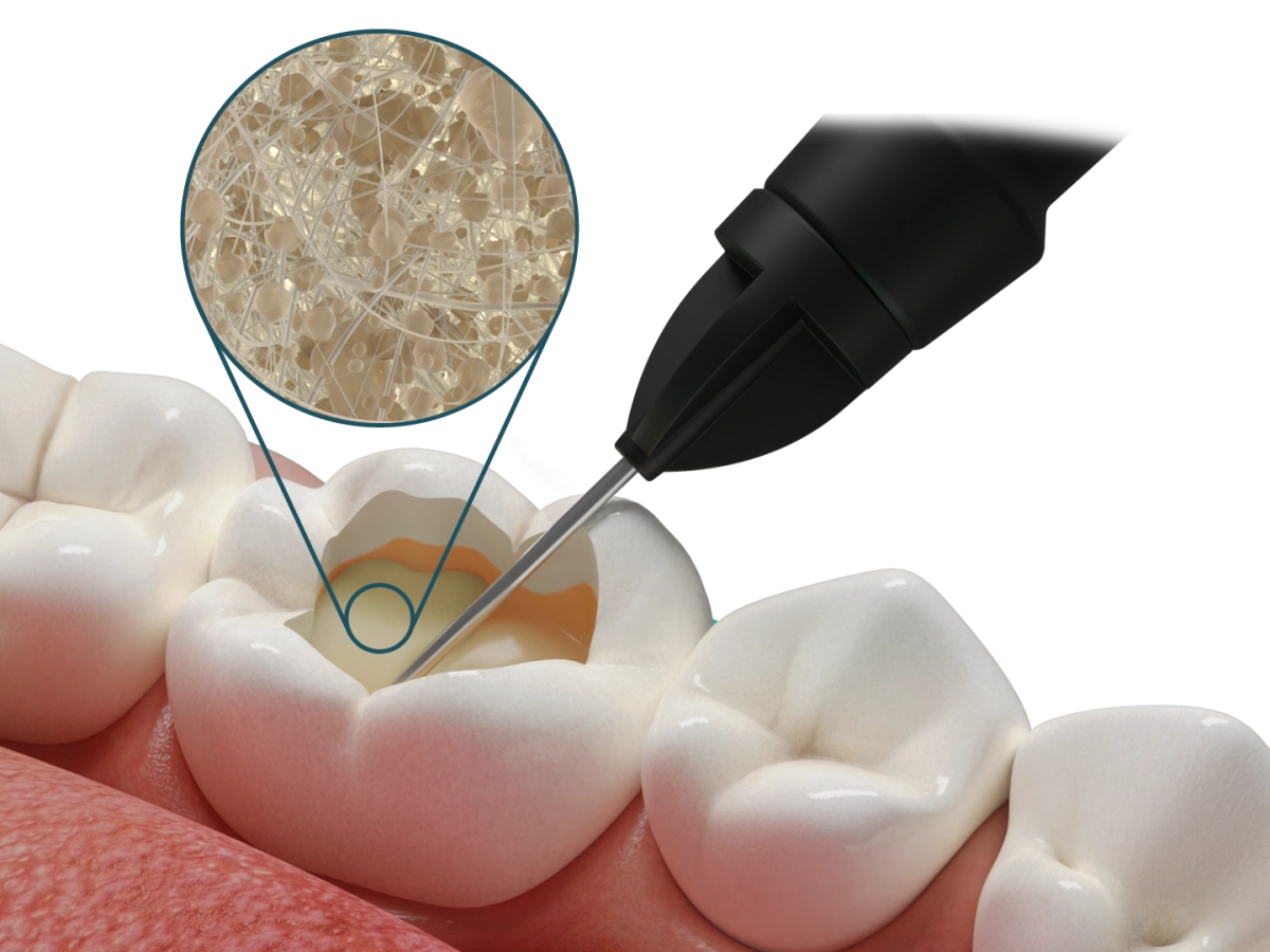 Fibrafill® FLOW – Dentapreg - ADM, a.s, Core Build-Up