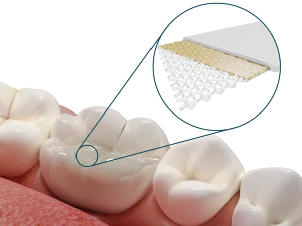 Dentapreg® UFM – Dentapreg - ADM, a.s, Stumpfaufbauten