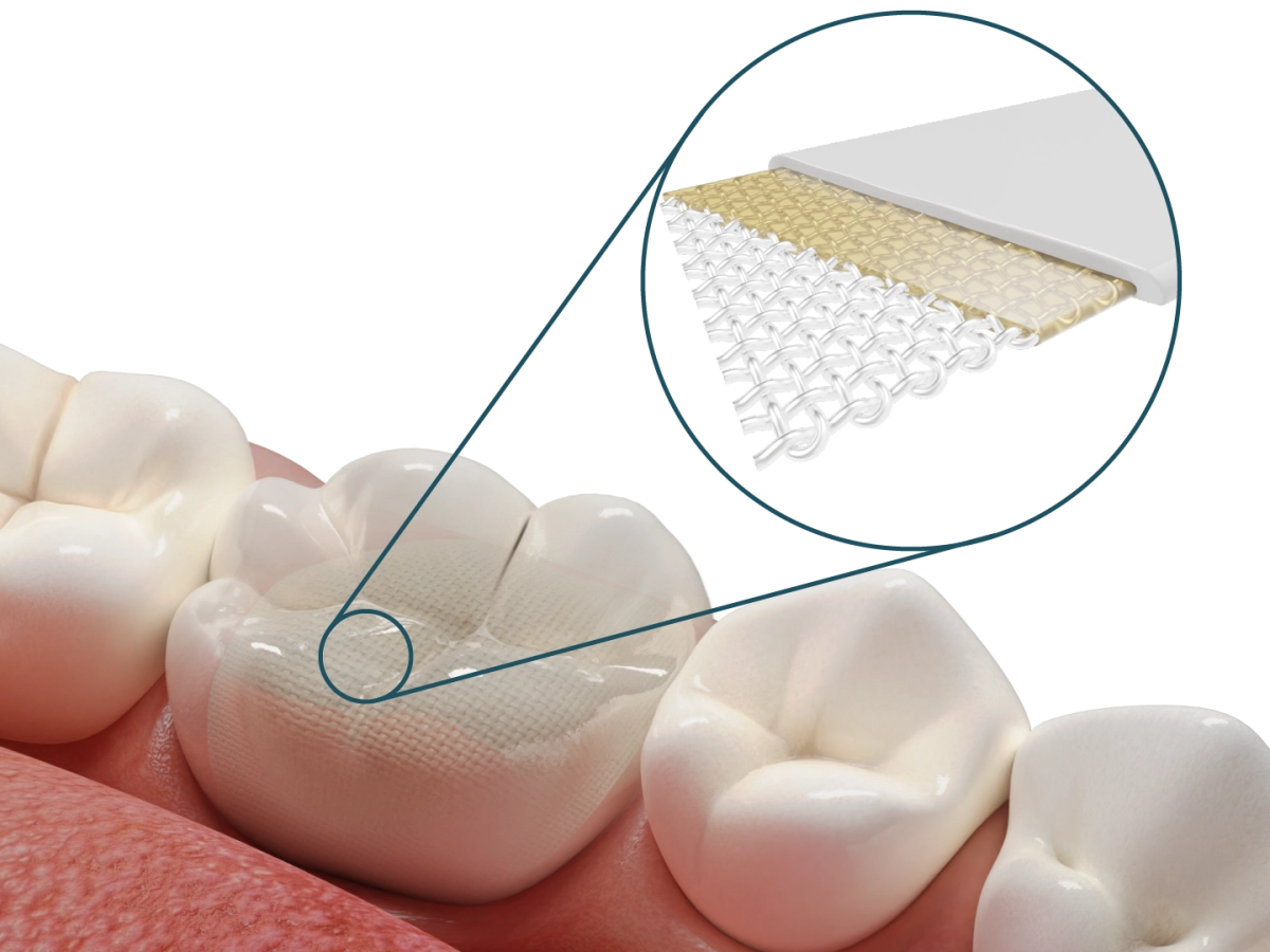 Dentapreg® UFM – Dentapreg - ADM, a.s, Composites
