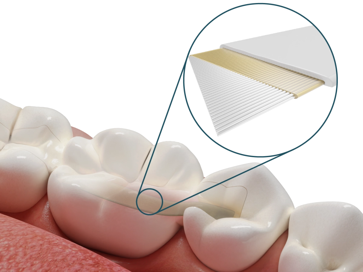 Dentapreg® PFU – Dentapreg - ADM, a.s, Temporary Crowns