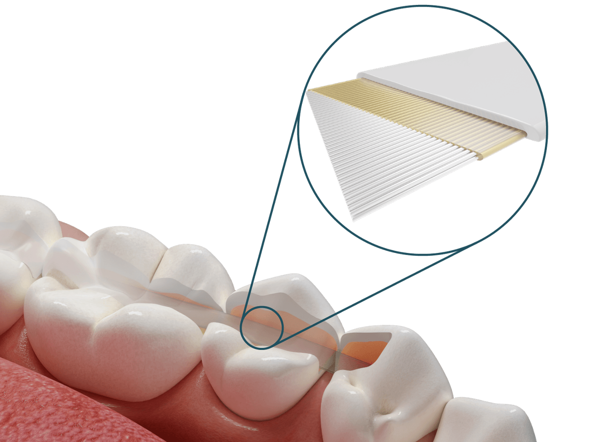 Dentapreg® SFU – Dentapreg - ADM, a.s, Temporary Crowns