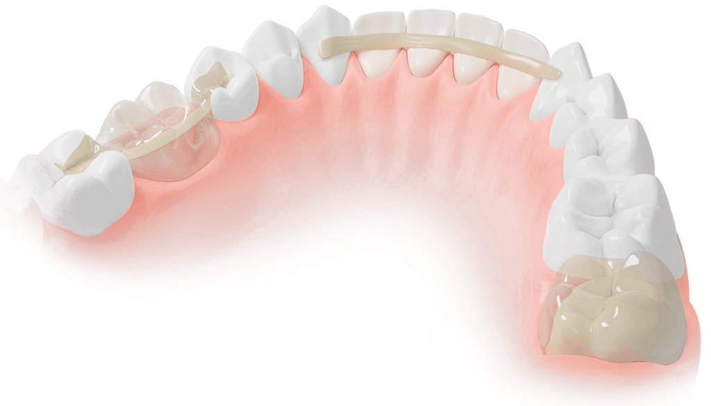Dentapreg & Fibrafill
