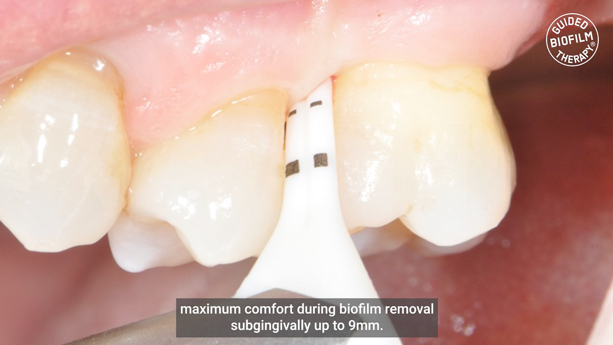Embout PERIOFLOW® MAX – EMS Electro Medical Systems, Periodontal Surgery
