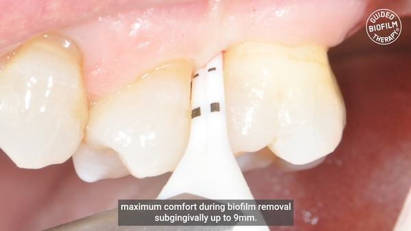 Embout PERIOFLOW® MAX