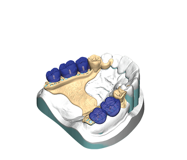 PartialCAD – Exocad, CAD/CAM Software