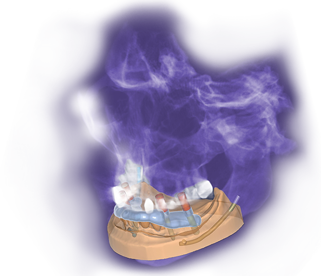 exoplan – Exocad, CAD/CAM-Software