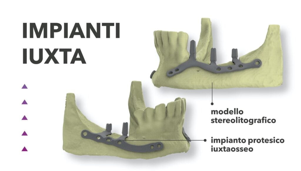 Impianti IUXTA Subperiostali