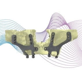 Implantes IUXTA