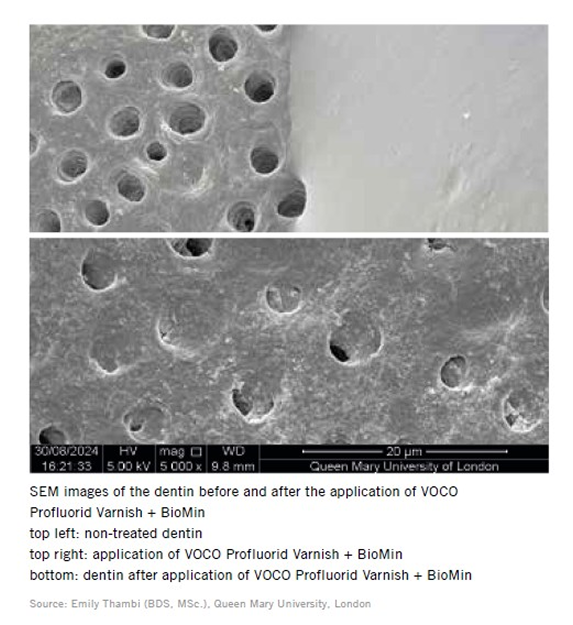 VOCO Profluorid Varnish + BioMin – BioMin Technologies Limited, Fluoridierung