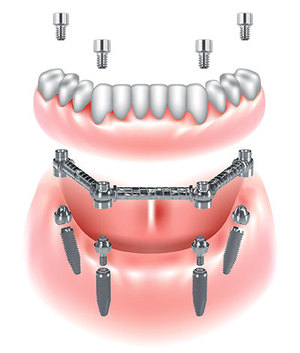 Dispositivo CAB – Clip Abutment Bar