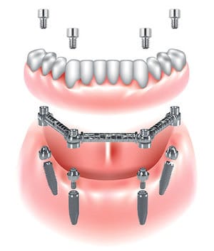 Dispositivo CAB – Clip Abutment Bar