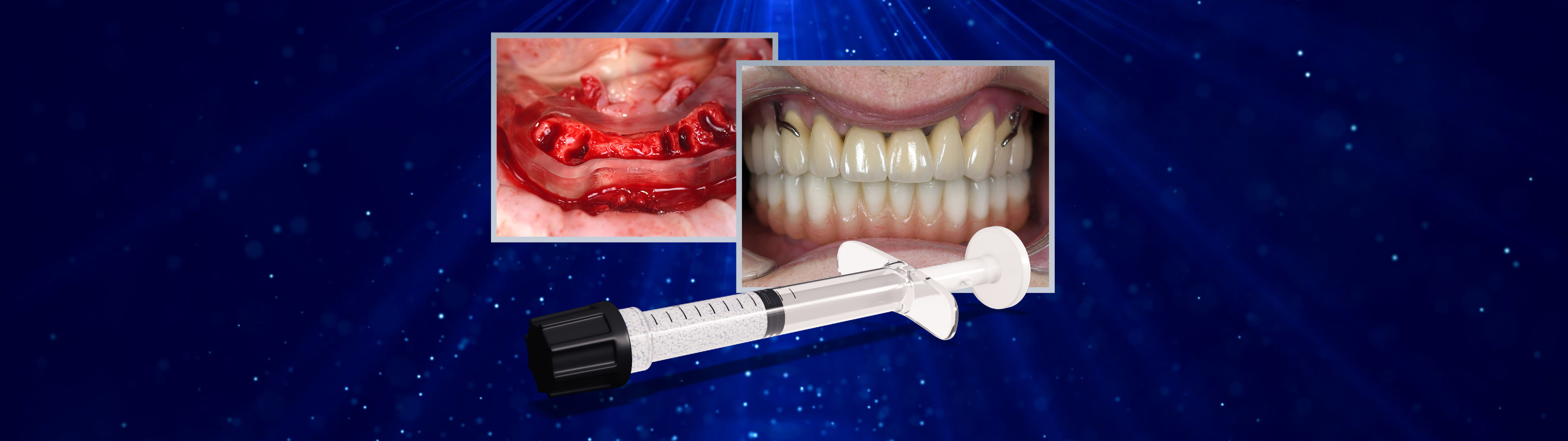 DSI Alyoss Plus Allograft