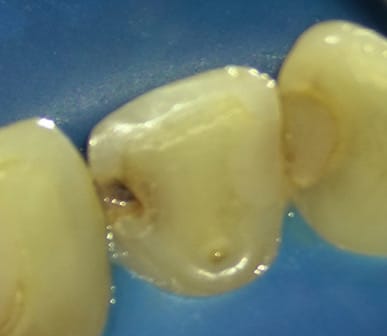 SilverSense SDF – Centrix, Inc., Fluoridation