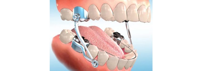 The Original Of Sleep Herbst Appliance – China Orthodontic lab, Intraoral Appliances
