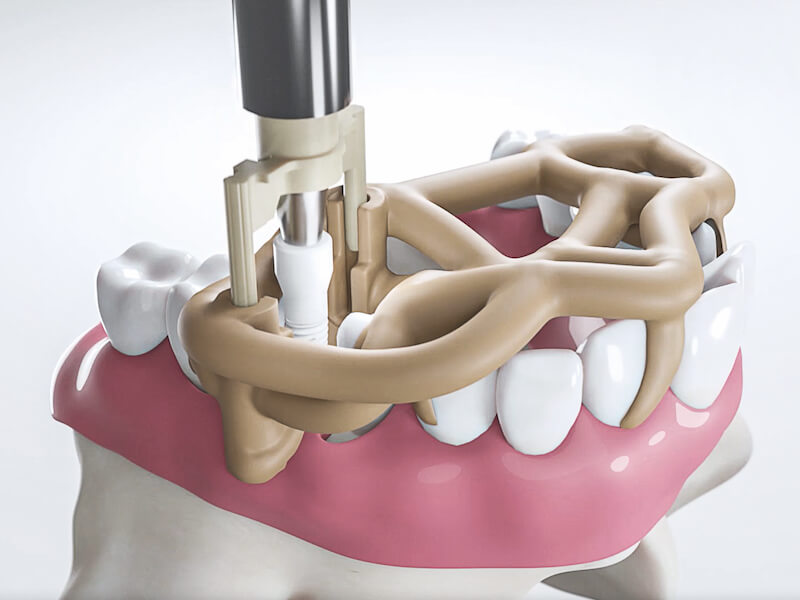 SDSBOX Full Navigation System – SDS Deutschland GmbH Swiss Dental Solutions, Implant Surgical Kits