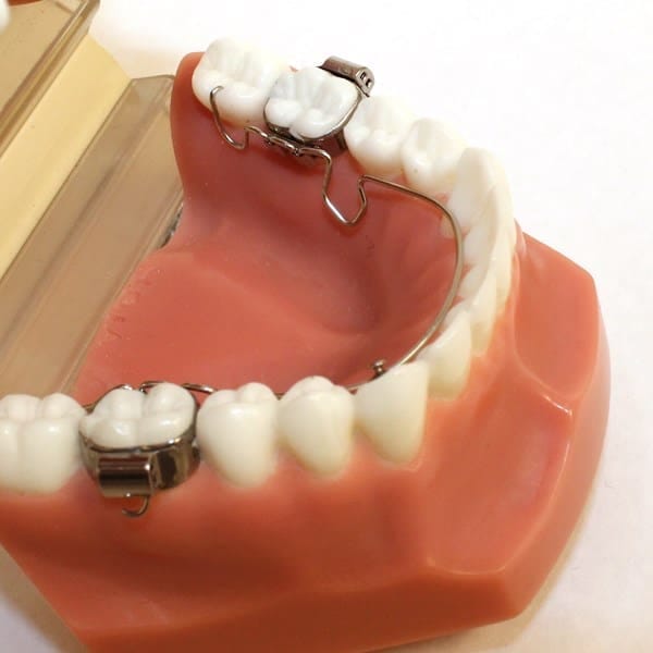 Wilson 3D Lingual Arch Pack of 3 – RMO, Intraoral Appliances
