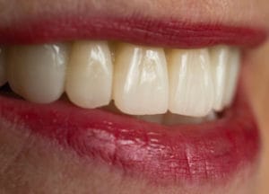 Dentalos Plus SG4a – DentalPlus, Resins
