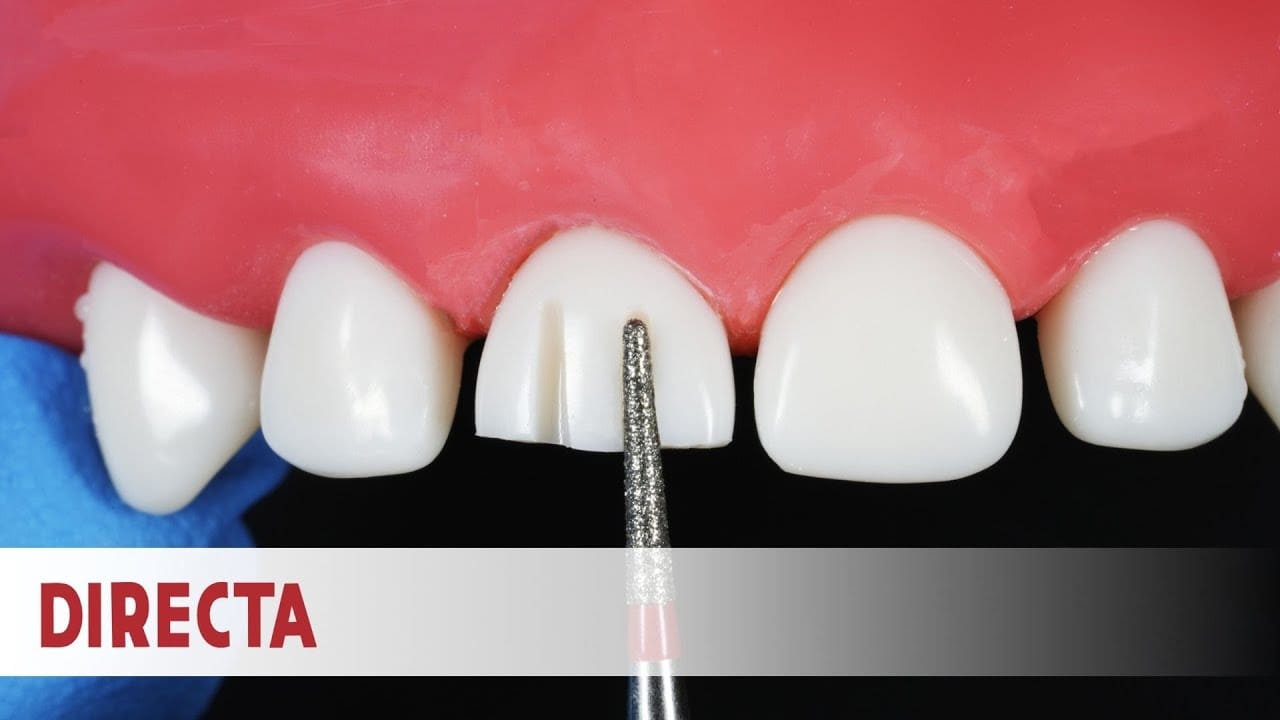 Ceramir Pediatric Crowns Kit