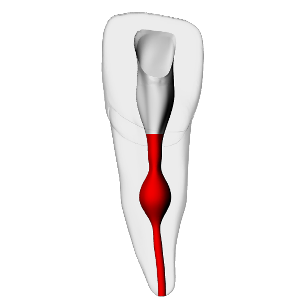 Incisor – Internal resorption, Radiopaque (White) | Dental Training Models | DRSK – DRSK Group AB, Gypsum Additives, Die Hardeners and Plaster Removers