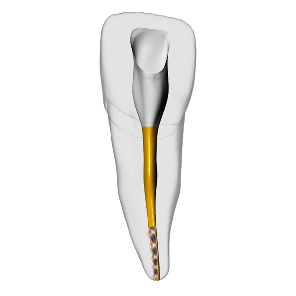 Incisor – Gutta percha, Broken file, White | Dental Training Models | DRSK