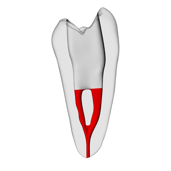 Premolar – Accessed, Merging canals, Radiopaque (White) | Dental Training Models | DRSK