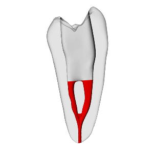 Premolar – Accessed, Merging canals, Clear, ~20# | Dental Training Models | DRSK – DRSK Group AB, Demomodelle