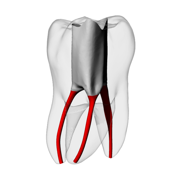 Molar – Accessed, Basic, Radiopaque (White) | Dental Training Models | DRSK