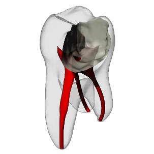 Molar – Pulp exposure, Clear | Dental Training Models | DRSK