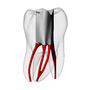 Molar – Accessed, Merging MB2, Clear, ~20# | Dental Training Models | DRSK