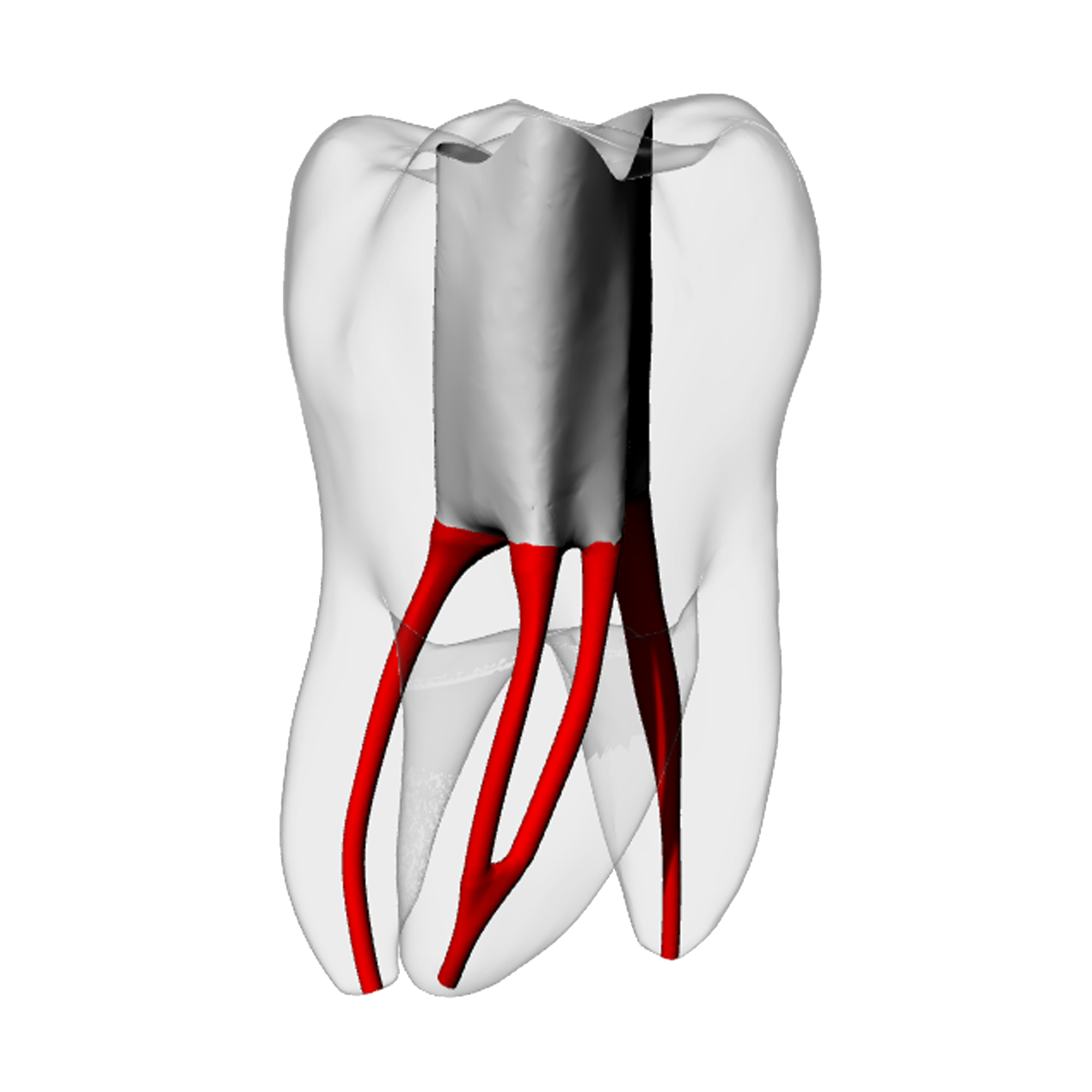 Molar – Accessed, Merging MB2, Radiopaque (White) | Dental Training Models | DRSK
