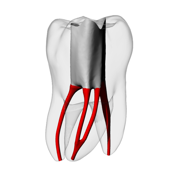 Molar – Accessed, Merging MB2, Radiopaque (White) | Dental Training Models | DRSK