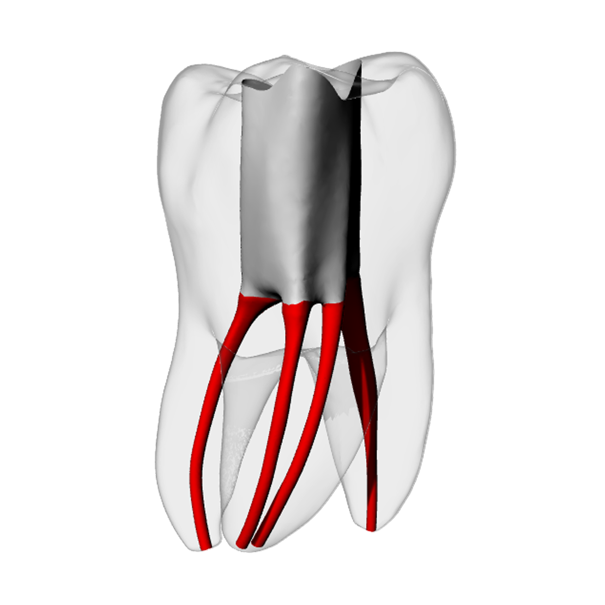 Molar – Accessed, MB2, Radiopaque (White) | Dental Training Models | DRSK – DRSK Group AB, Zubehör für Wurzelbehandlung