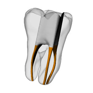 Molar – Accessed, Gutta percha, Clear | Dental Training Models | DRSK