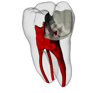 Molar – Pulp exposure, Radiopaque (White) | Dental Training Models | DRSK – DRSK Group AB, Demomodelle
