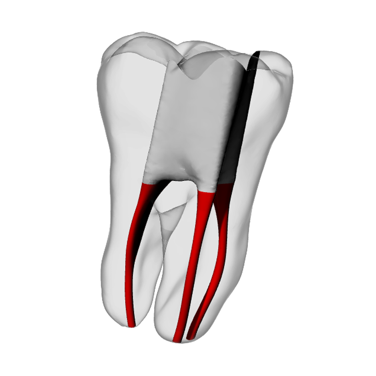 Molar – Accessed, Basic, Clear | Dental Training Models | DRSK – DRSK Group AB, Demonstration Models