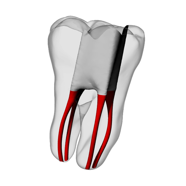 Molar – Accessed, Four canals, Clear | Dental Training Models | DRSK