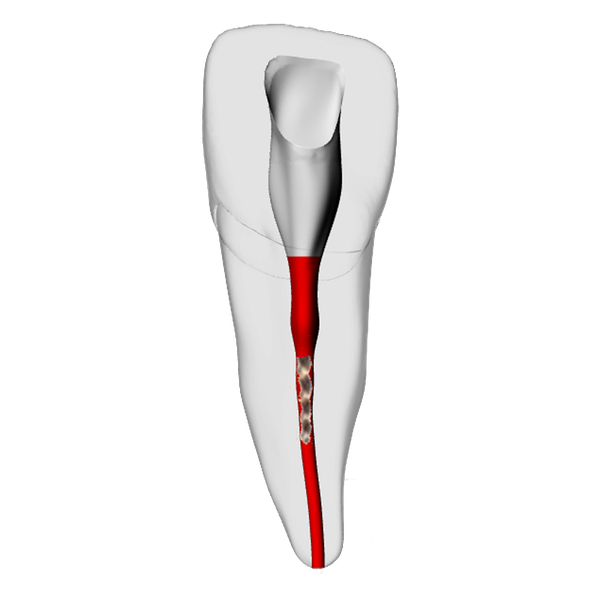 Incisor – Broken file | Dental Training Models | DRSK