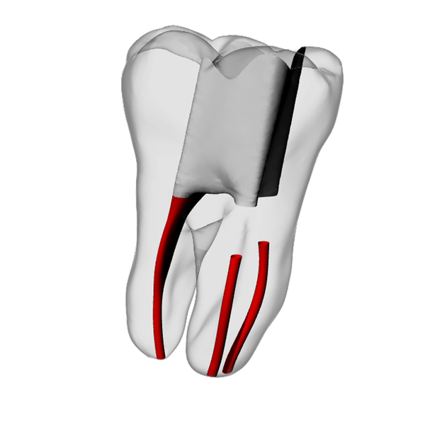 Molar – Obliterated, Radiopaque (White) | Dental Training Models | DRSK