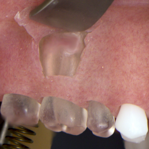 Apicoectomy Model – DRSK Group AB, Demomodelle